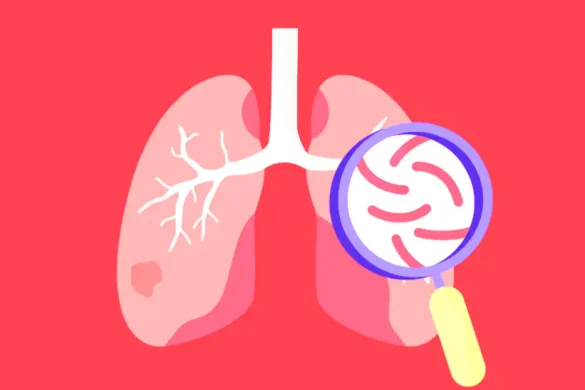 Mengenal Skrining Dini Tuberkulosis: Mengapa Deteksi Cepat Sangat Penting?