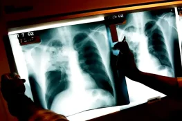 Deteksi Dini Tuberkulosis: Langkah Sederhana yang Dapat Menyelamatkan Banyak Nyawa